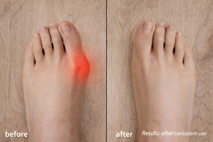AlignStep™ Bunion Relief